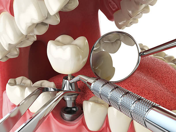 Best Root Canal Emergency Dentist  in Lakewood, WA
